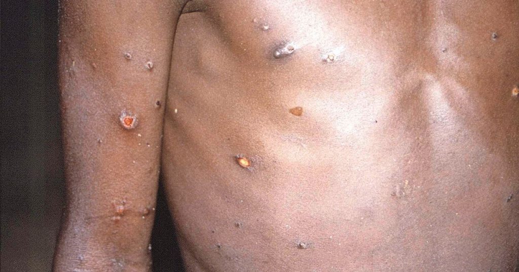 Up to three weeks of quarantine after contact with a monkeypox patient |  abroad
