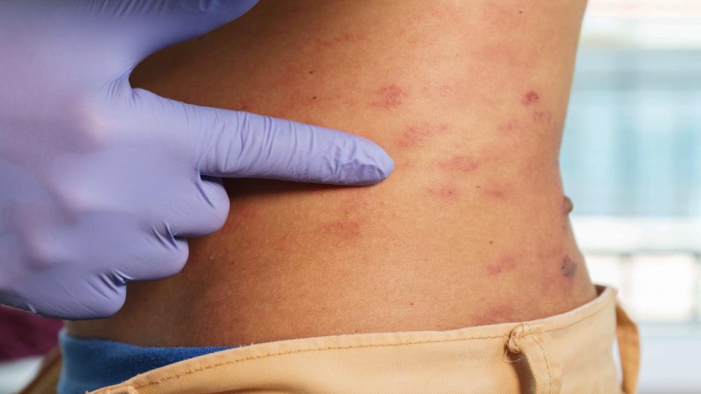 Here's what you need to know about shingles: "The itch and pain can be crazy" |  health